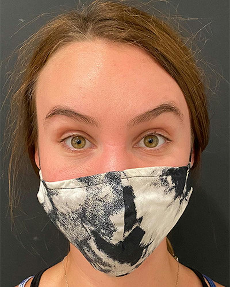 BOTOX Before & After Gallery - Patient 122903 - Image 2