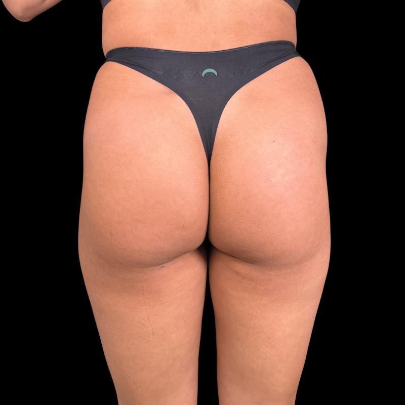 Buttock Augmentation Before & After Gallery - Patient 158722 - Image 1