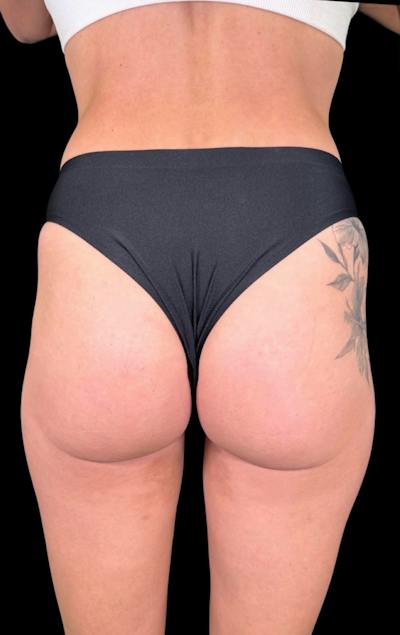 Buttock Augmentation Before & After Gallery - Patient 175006 - Image 1
