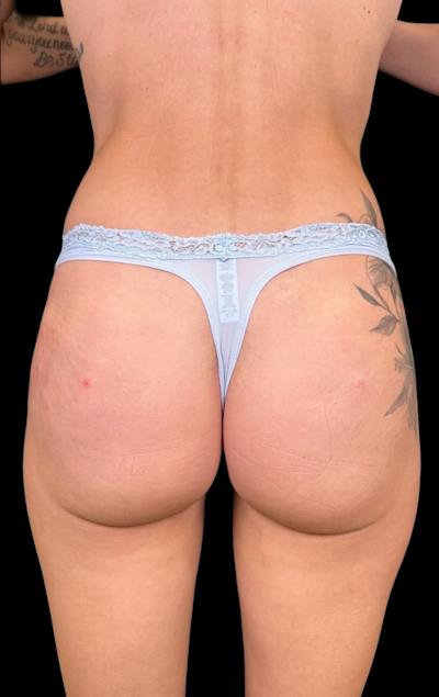 Buttock Augmentation Before & After Gallery - Patient 175006 - Image 2