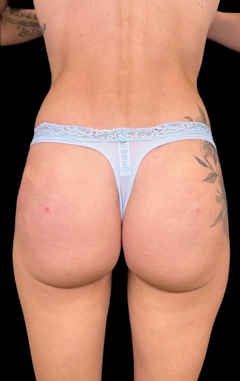 Buttock Augmentation Before & After Gallery - Patient 175006 - Image 2