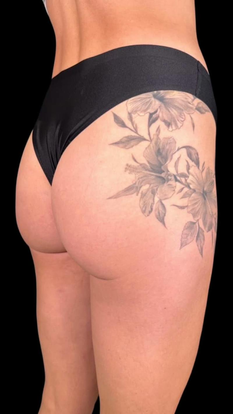 Buttock Augmentation Before & After Gallery - Patient 175006 - Image 3