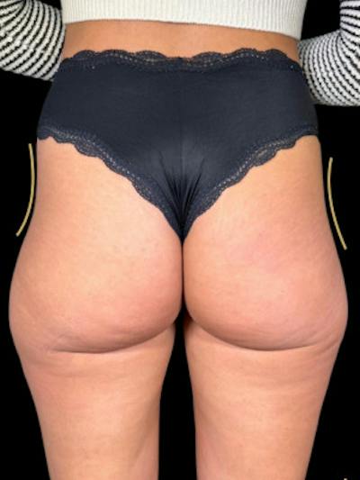 Buttock Augmentation Before & After Gallery - Patient 205339 - Image 1