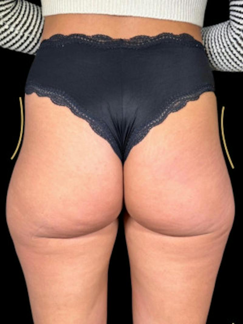 Buttock Augmentation Before & After Gallery - Patient 205339 - Image 1