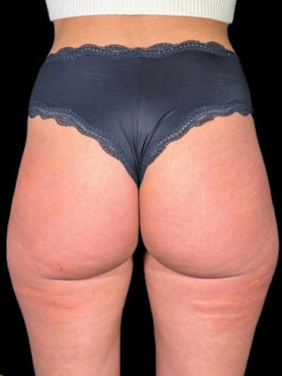 Buttock Augmentation Before & After Gallery - Patient 205339 - Image 2