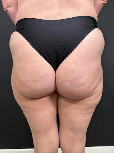 Buttock Augmentation Before & After Gallery - Patient 410432 - Image 1
