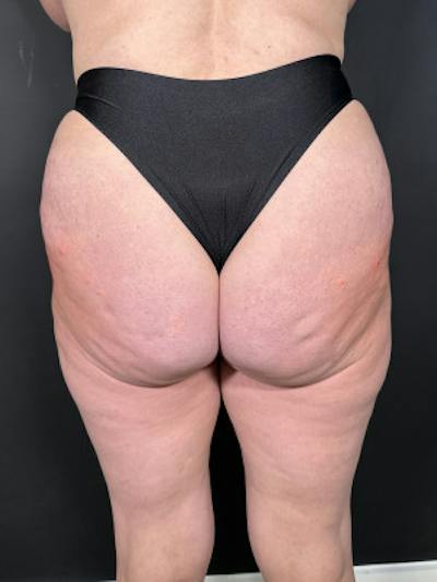 Buttock Augmentation Before & After Gallery - Patient 410432 - Image 2