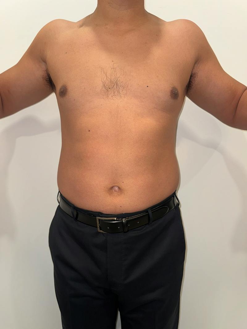 Emsculpt Neo Before & After Gallery - Patient 342729 - Image 1