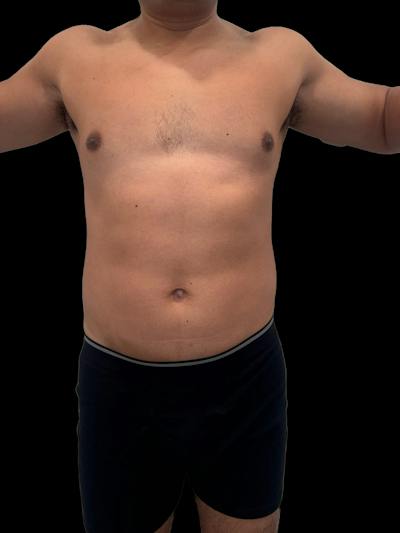 Emsculpt Neo Before & After Gallery - Patient 342729 - Image 2