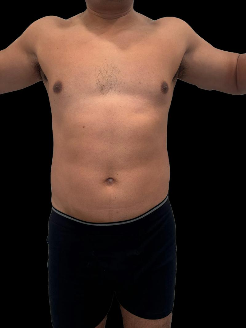 Emsculpt Neo Before & After Gallery - Patient 342729 - Image 2