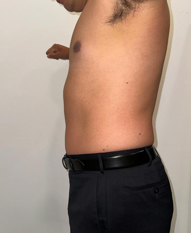Emsculpt Neo Before & After Gallery - Patient 342729 - Image 3