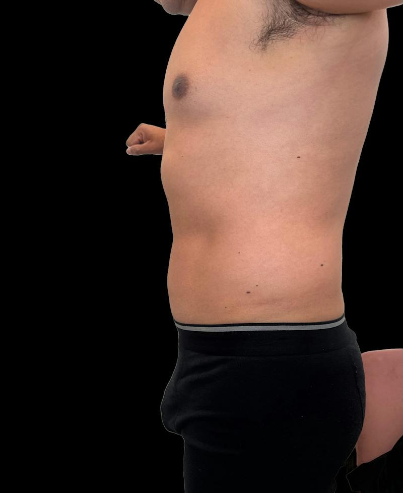Emsculpt Neo Before & After Gallery - Patient 342729 - Image 4
