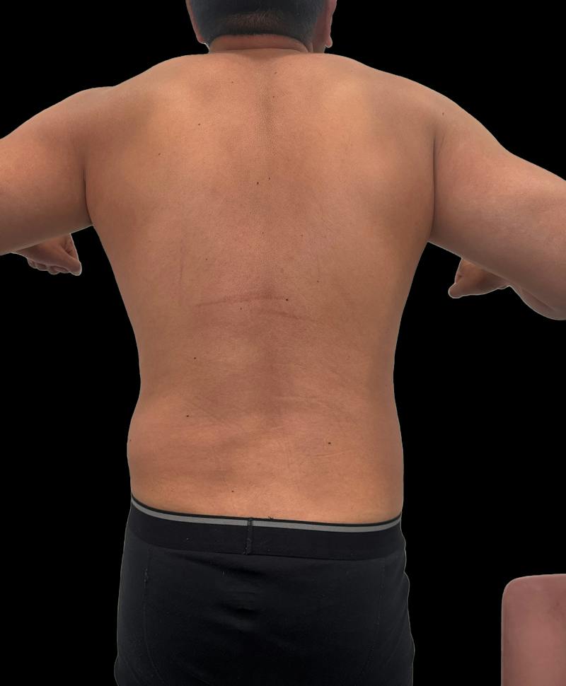 Emsculpt Neo Before & After Gallery - Patient 342729 - Image 6