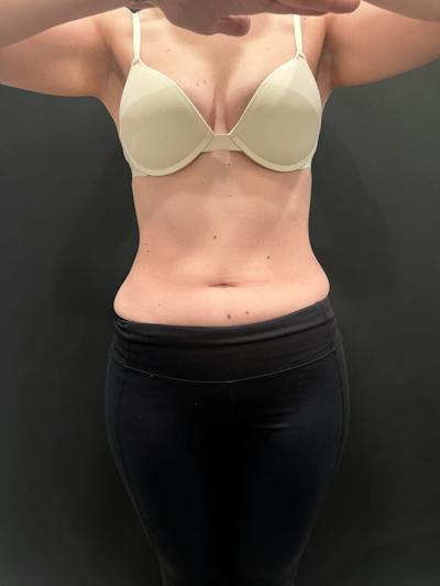 Emsculpt Neo Before & After Gallery - Patient 982607 - Image 1