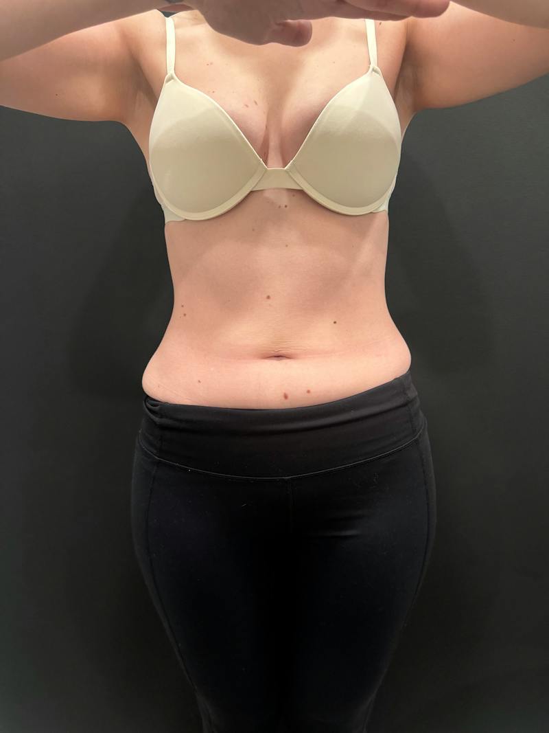 Emsculpt Neo Before & After Gallery - Patient 982607 - Image 1