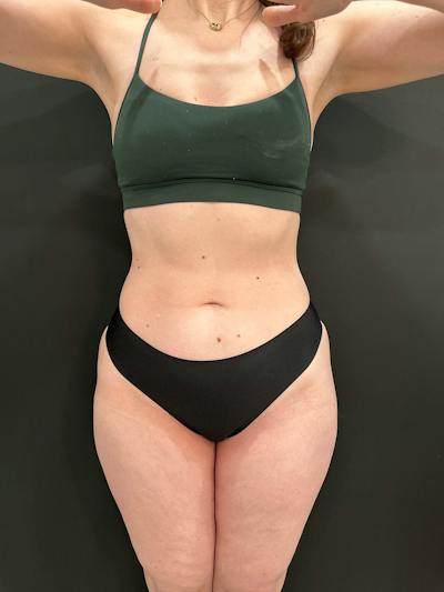Emsculpt Neo Before & After Gallery - Patient 982607 - Image 2