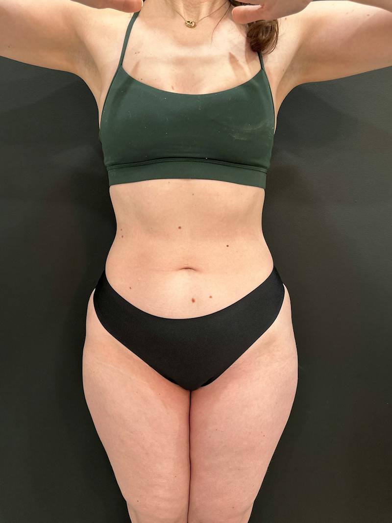 Emsculpt Neo Before & After Gallery - Patient 982607 - Image 2