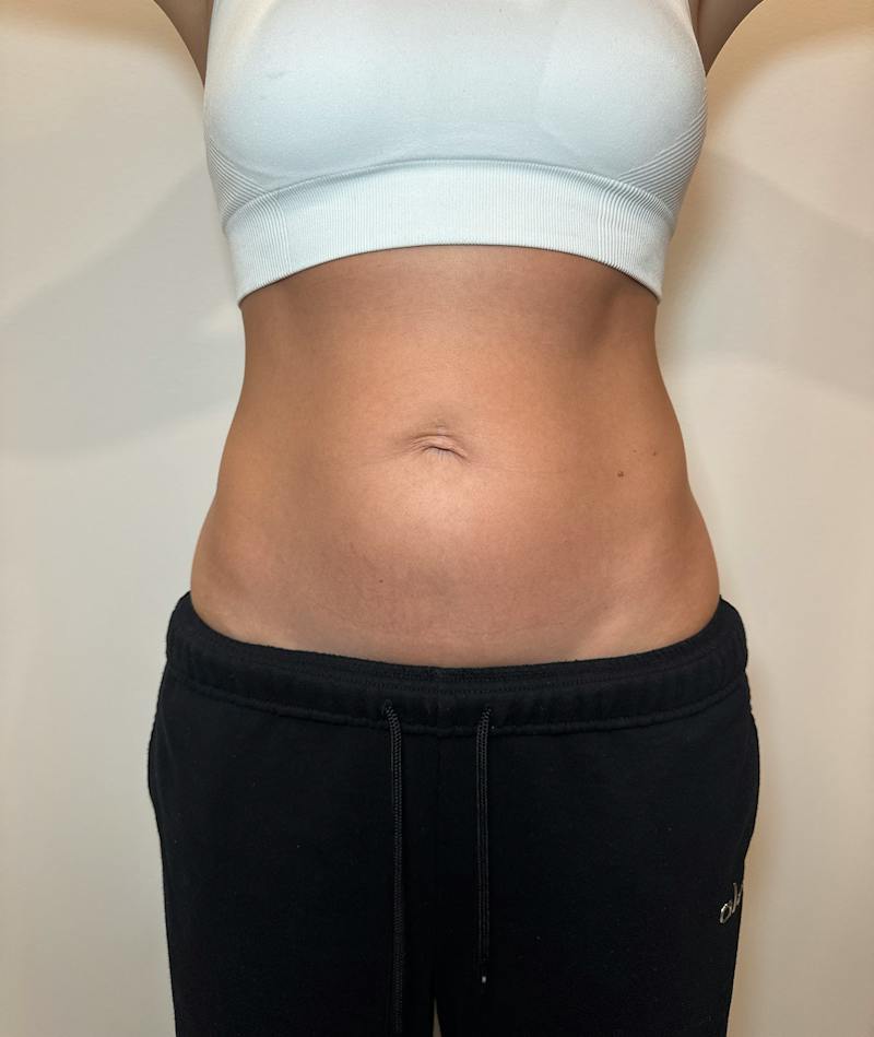 Emsculpt Neo Before & After Gallery - Patient 346664 - Image 1