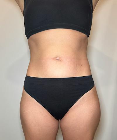 Emsculpt Neo Before & After Gallery - Patient 346664 - Image 2