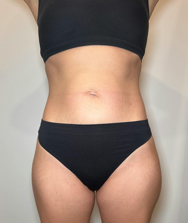 Emsculpt Neo Before & After Gallery - Patient 346664 - Image 2