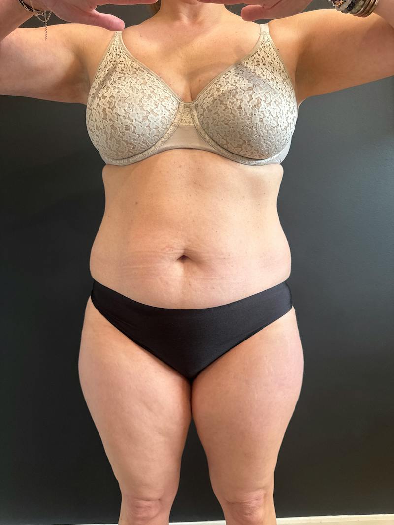 Emsculpt Neo Before & After Gallery - Patient 924491 - Image 1