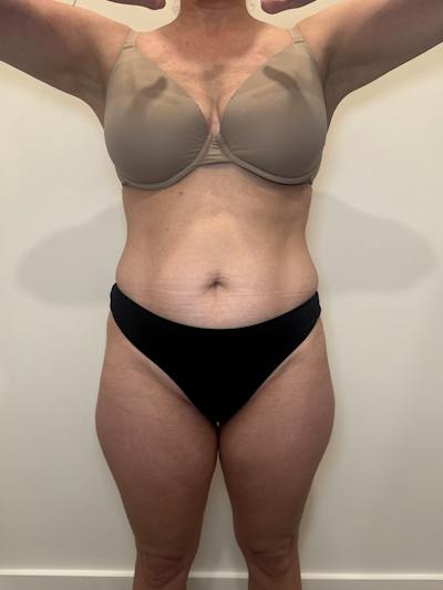 Emsculpt Neo Before & After Gallery - Patient 924491 - Image 2