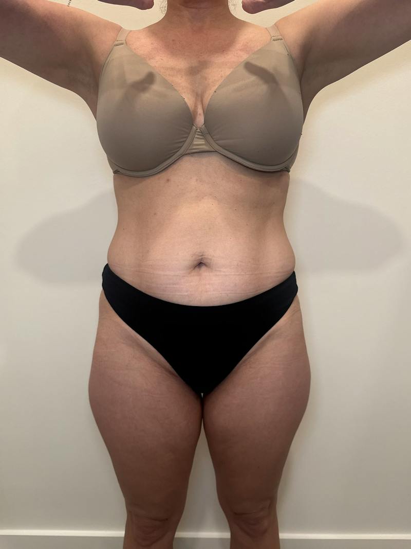 Emsculpt Neo Before & After Gallery - Patient 924491 - Image 2