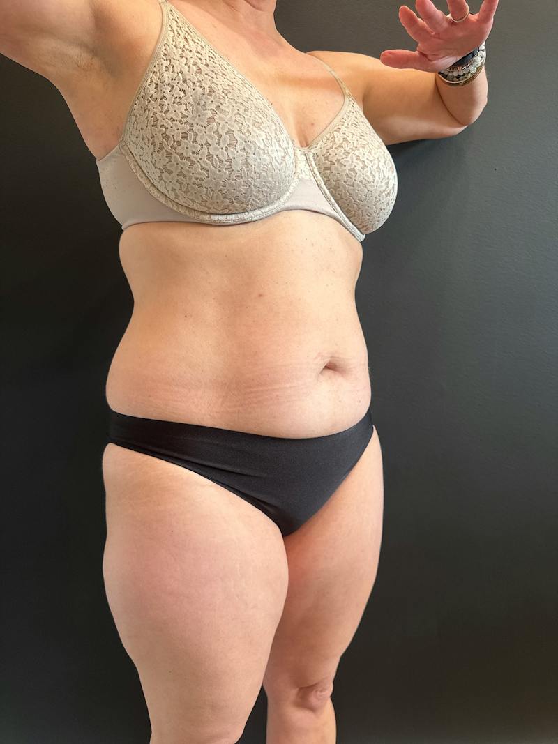 Emsculpt Neo Before & After Gallery - Patient 924491 - Image 3