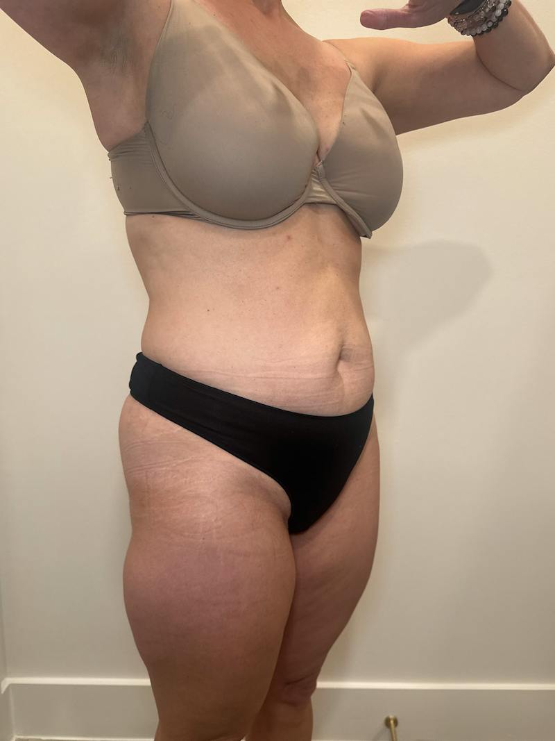 Emsculpt Neo Before & After Gallery - Patient 924491 - Image 4