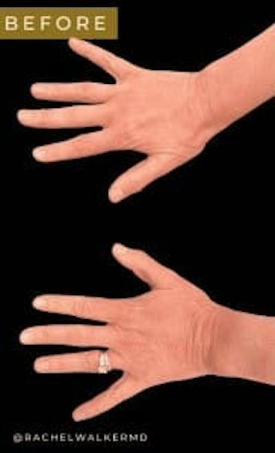 Fat Transfer to Hands Before & After Gallery - Patient 195210 - Image 1