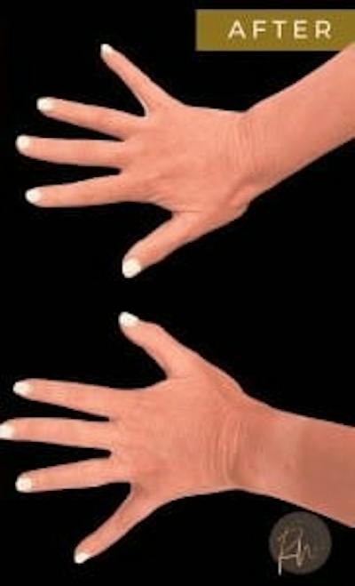 Fat Transfer to Hands Before & After Gallery - Patient 195210 - Image 2