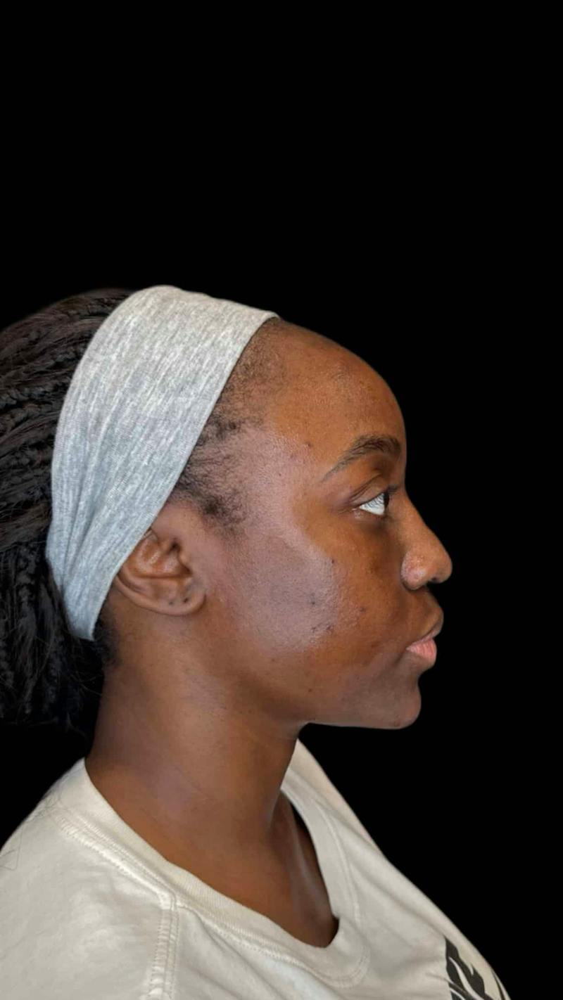 Filler Before & After Gallery - Patient 301907 - Image 1