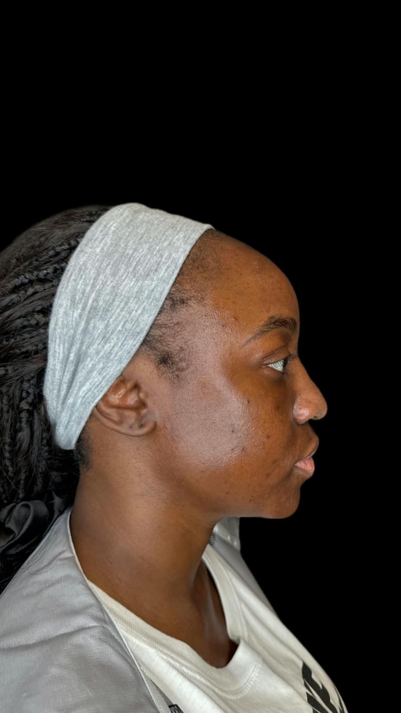 Filler Before & After Gallery - Patient 301907 - Image 2
