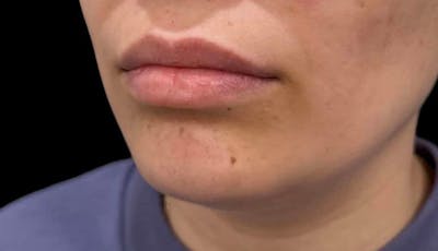Filler Before & After Gallery - Patient 648993 - Image 1