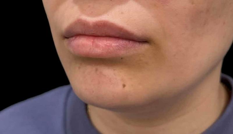 Filler Before & After Gallery - Patient 648993 - Image 1