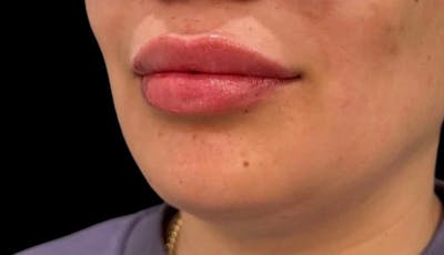 Filler Before & After Gallery - Patient 648993 - Image 2