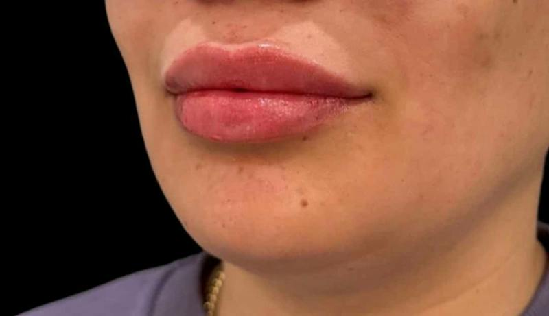 Filler Before & After Gallery - Patient 648993 - Image 2