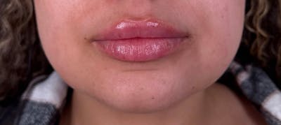Filler Before & After Gallery - Patient 292013 - Image 2
