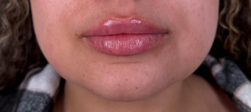 Filler Before & After Gallery - Patient 292013 - Image 2
