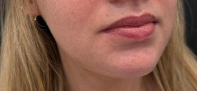 Filler Before & After Gallery - Patient 332080 - Image 1