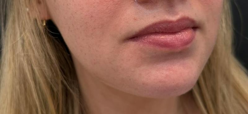 Filler Before & After Gallery - Patient 332080 - Image 1