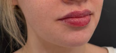 Filler Before & After Gallery - Patient 332080 - Image 2