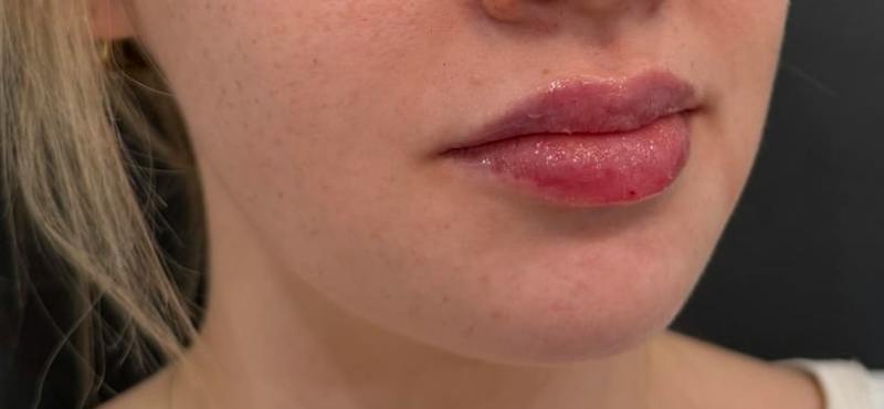 Filler Before & After Gallery - Patient 332080 - Image 2