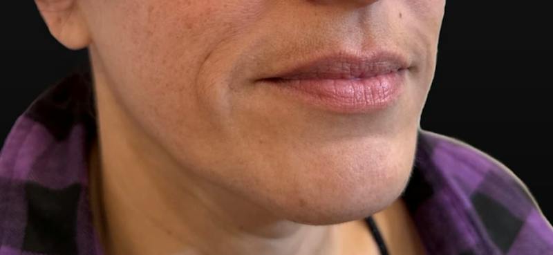 Filler Before & After Gallery - Patient 193408 - Image 1