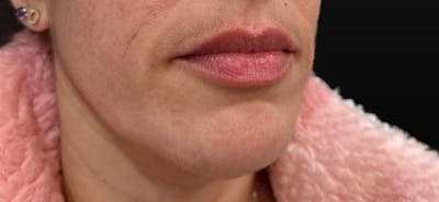 Filler Before & After Gallery - Patient 193408 - Image 2