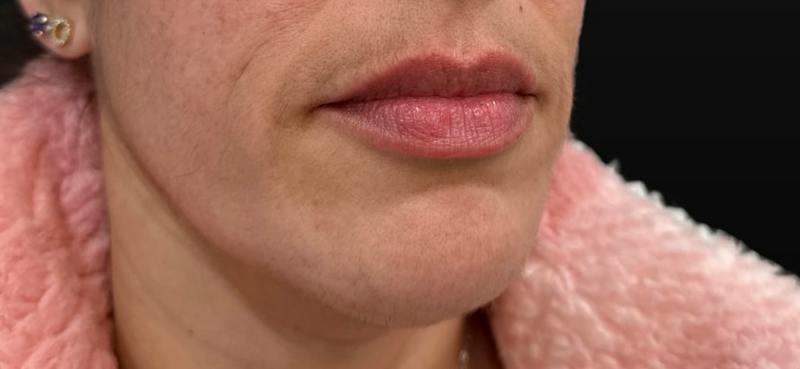 Filler Before & After Gallery - Patient 193408 - Image 2