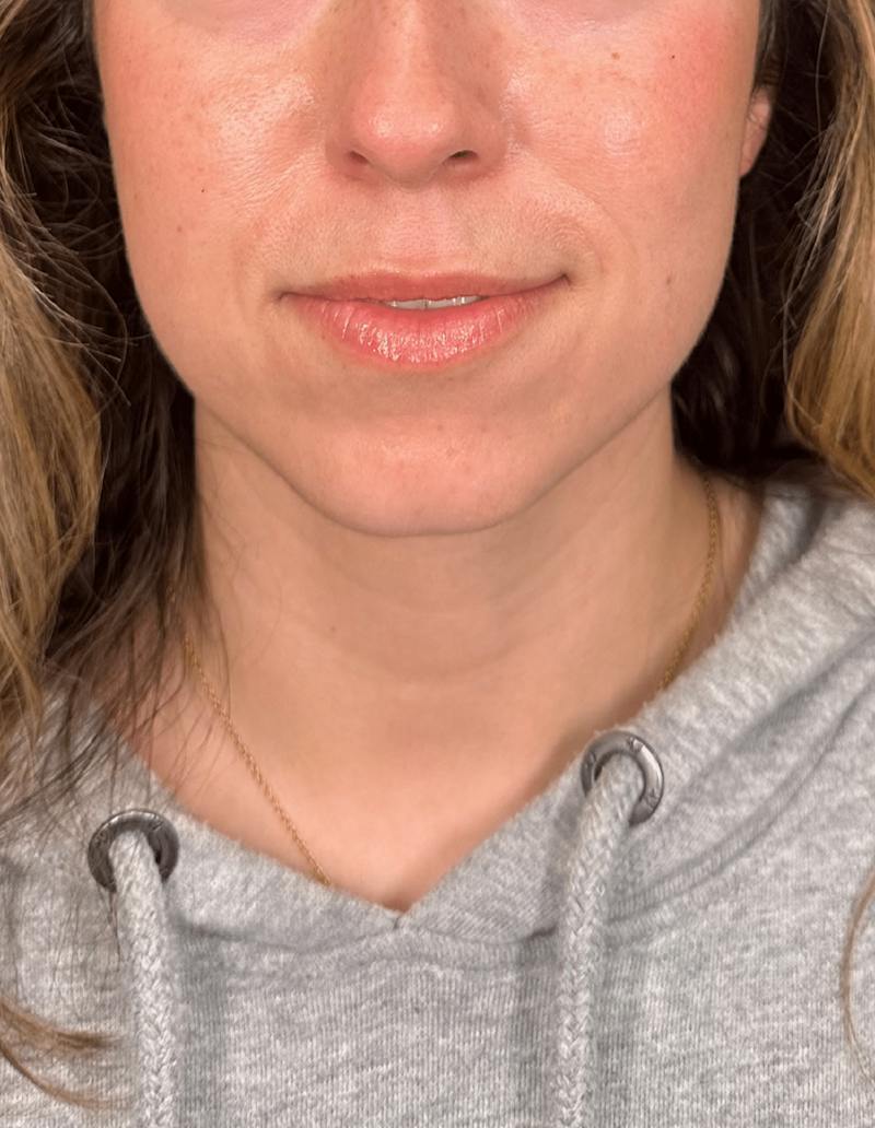 Filler Before & After Gallery - Patient 394137 - Image 1