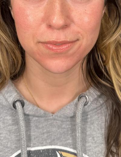 Filler Before & After Gallery - Patient 394137 - Image 2