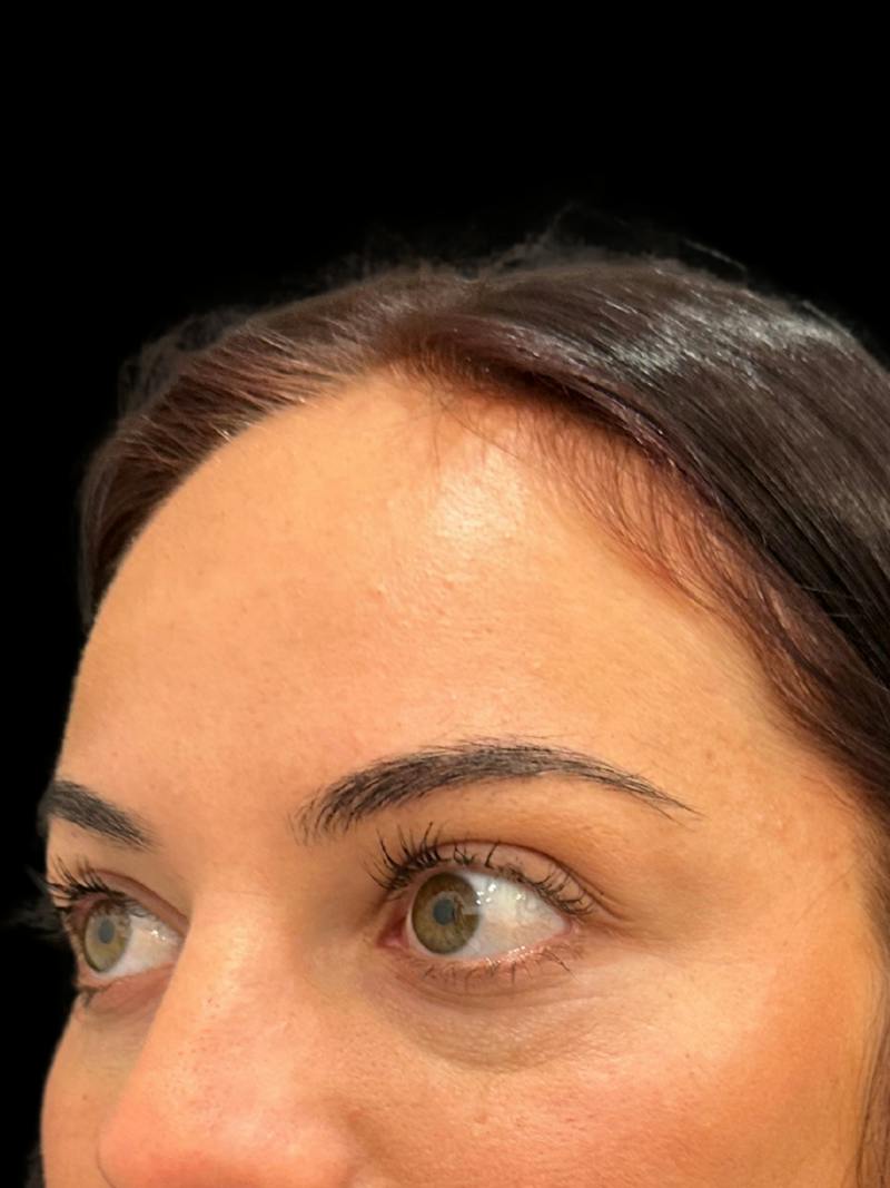 Filler Before & After Gallery - Patient 317281 - Image 1