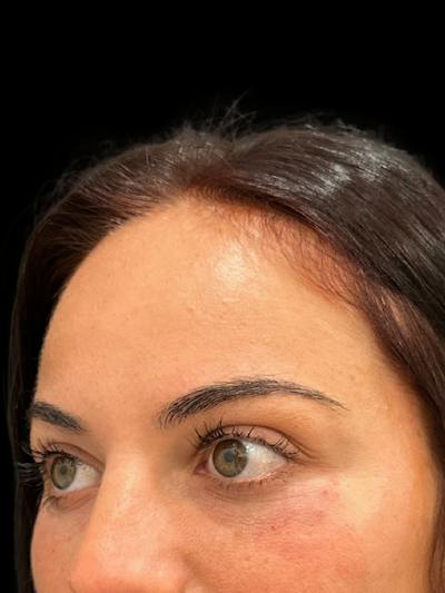 Filler Before & After Gallery - Patient 317281 - Image 2